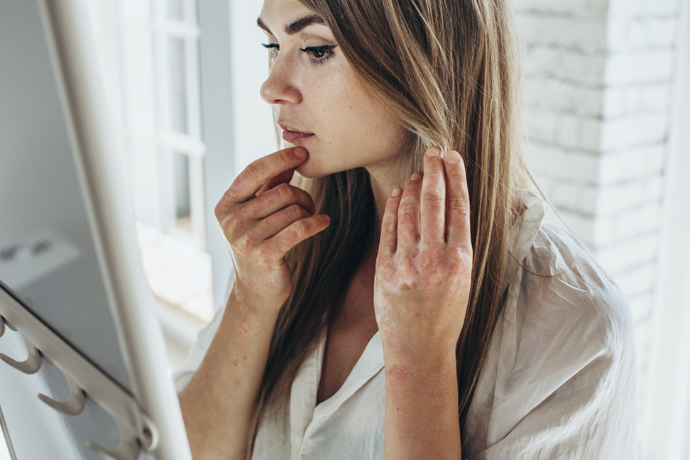 Young adult woman with a rare skin disease on her arms and hands 